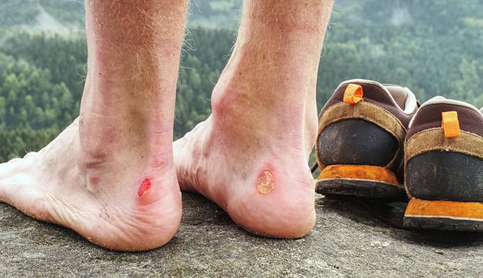 Hiking_Blisters_Prevention_And_Treatment